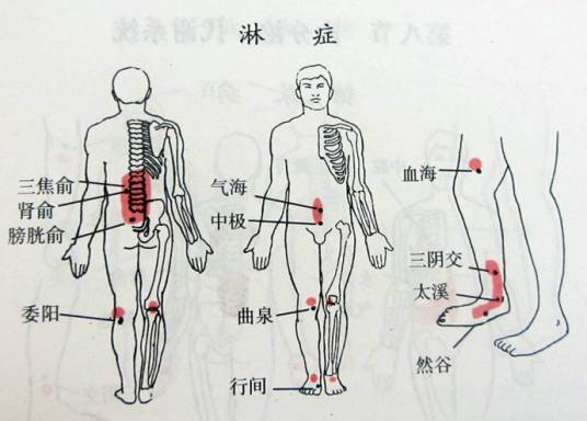 淋症