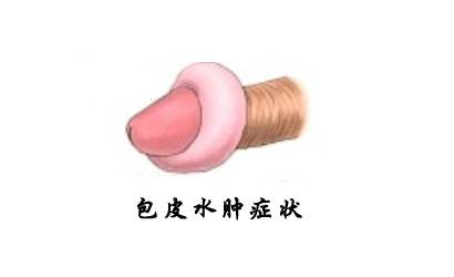 包皮系带手术