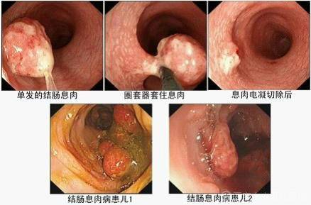结肠息肉症