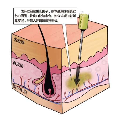 人类生长因子