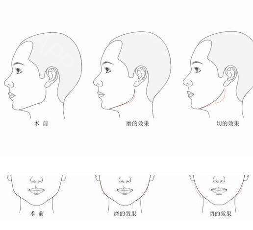 下颌角磨切术