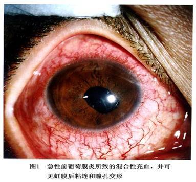 葡萄膜炎综合征