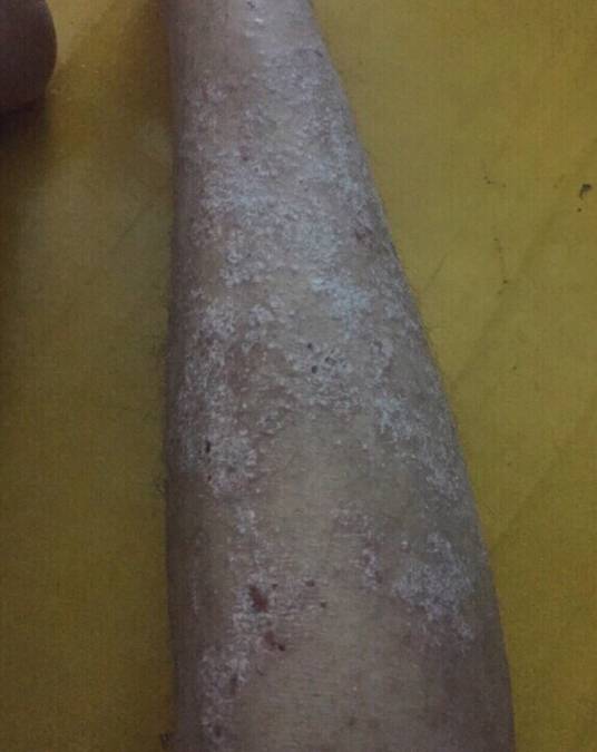 顽固性银屑病