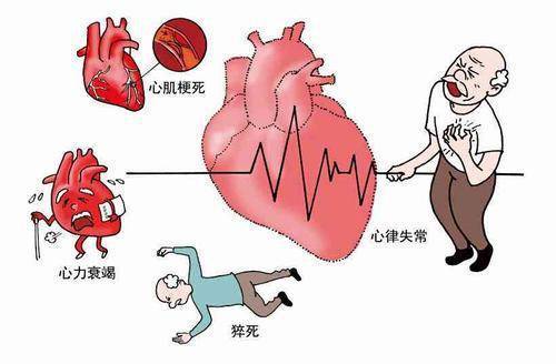 冠心病的临床表现
