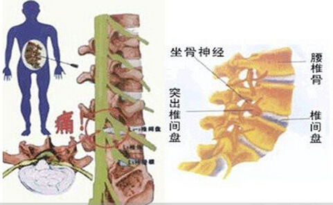 腰椎间盘突出症的手法治疗