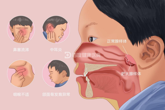 腺样体肥大