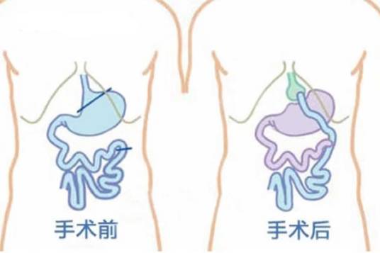 糖尿病胃转流手术
