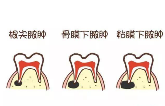牙疼症