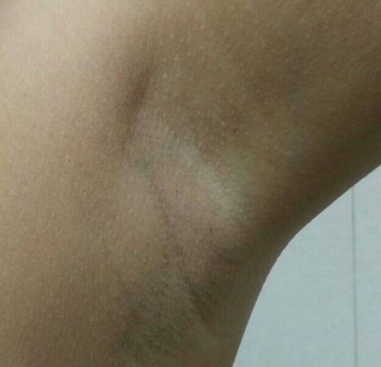 微创去腋臭