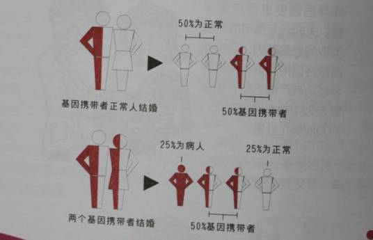 α-地中海贫血