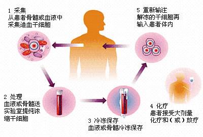 自体干细胞移植